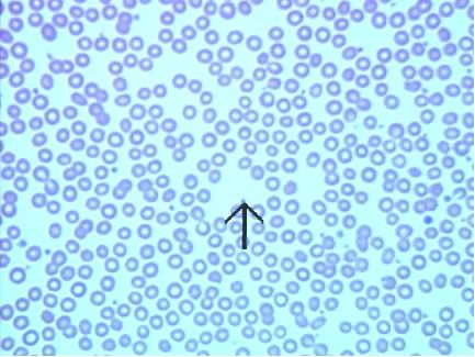 What causes elevated blood platelets?