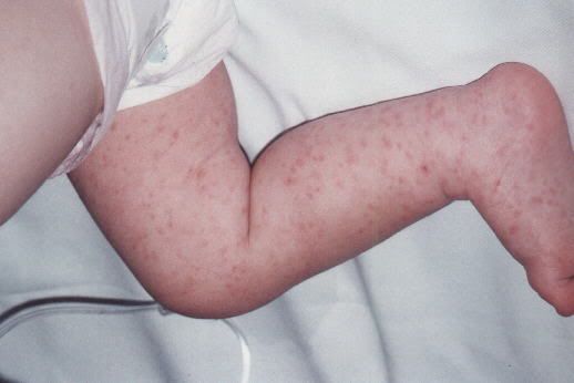 Baby Rash On Chest Meningitis