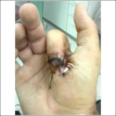 body itching from percocet