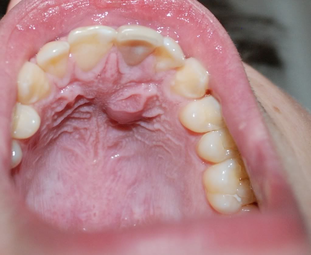 sore roof of mouth near front teeth