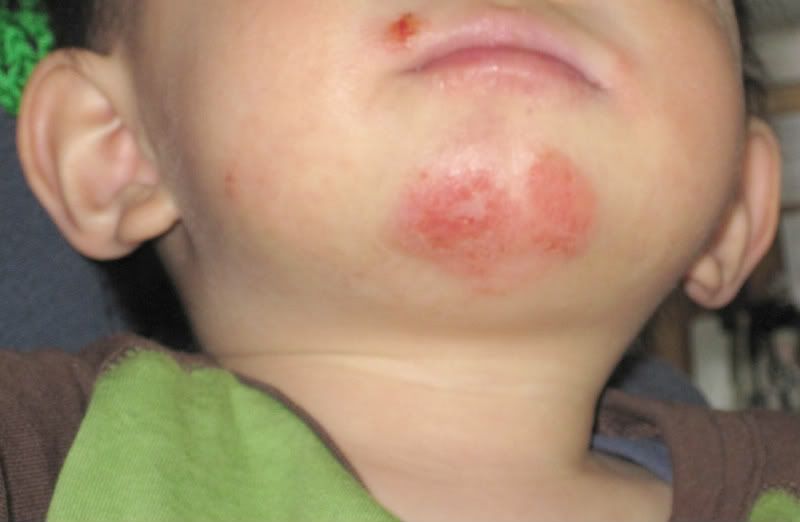 Slide show: Common skin rashes - Mayo Clinic