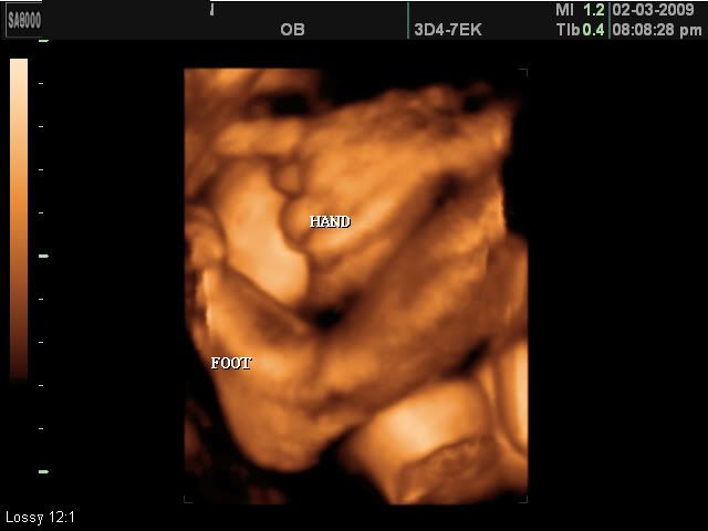 3d ultrasound pictures at 26 weeks. Hailey at 26 weeks