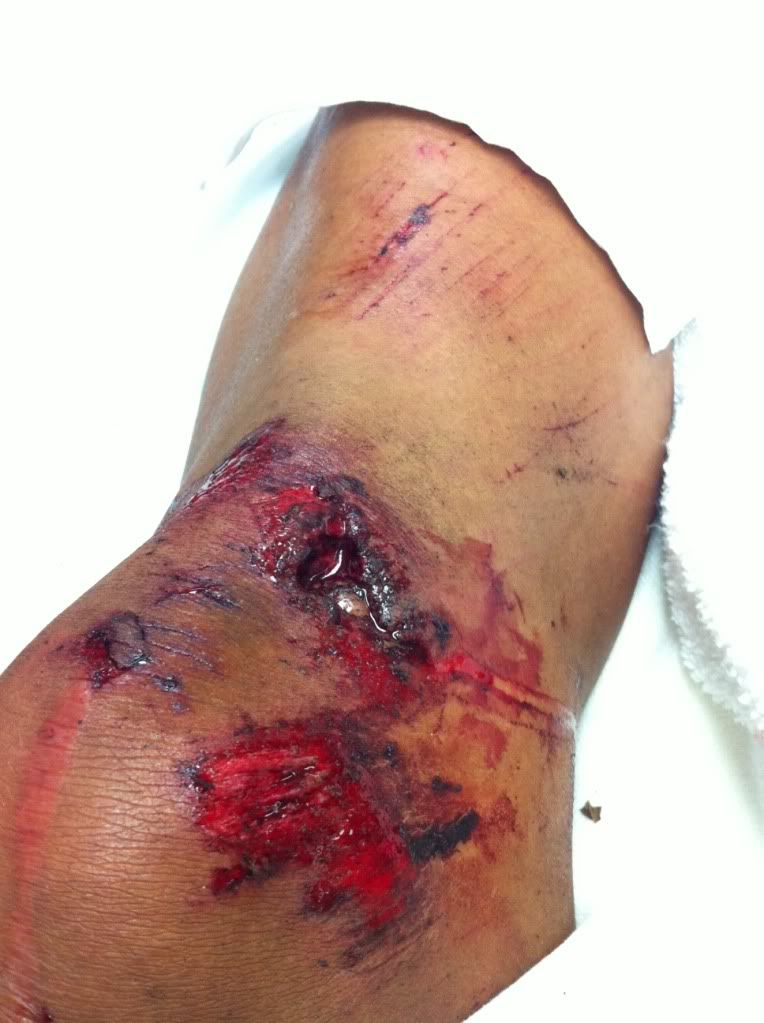 injured knee