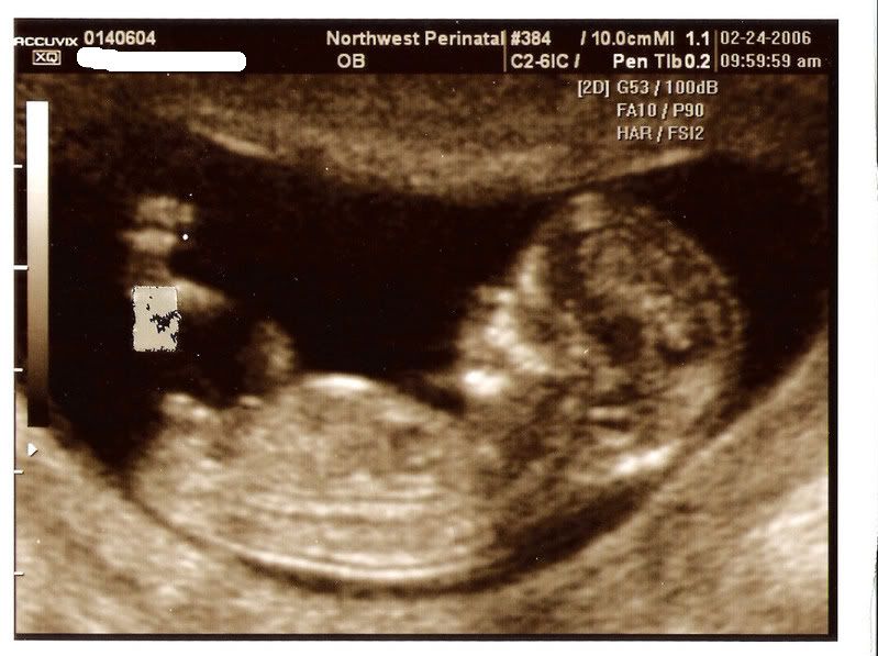12 5 week ultrasound. in his 12 week ultrasound: