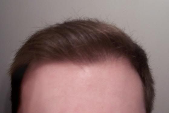 Propecia Hairline