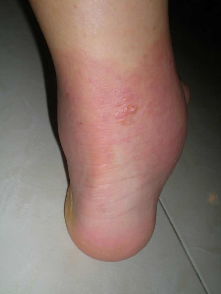 ankle rashes