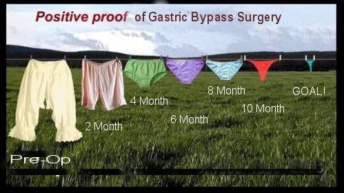 GastricBypass.jpg Stages of Gastric Bypass image by Marinemoms
