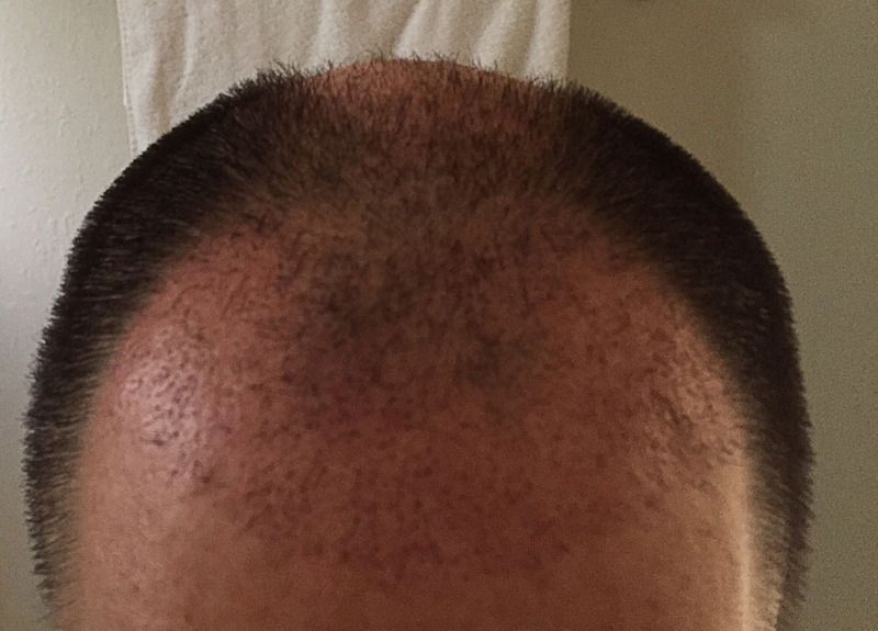 techie_fue_1month_hairline_zps045mpdel.jpg
