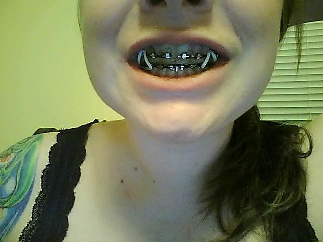 Jens Braces Adventure Better Pictures Metal Mouth Message Bo