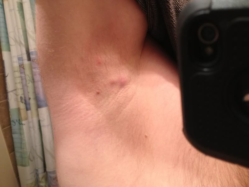 Small Lump In Armpit Hurts