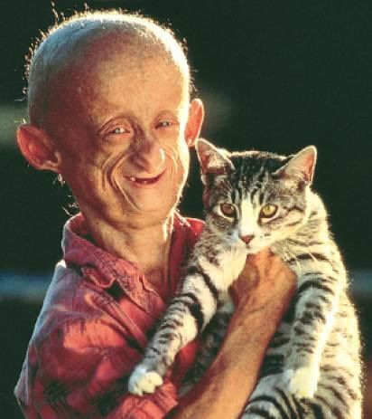 progeria.jpg