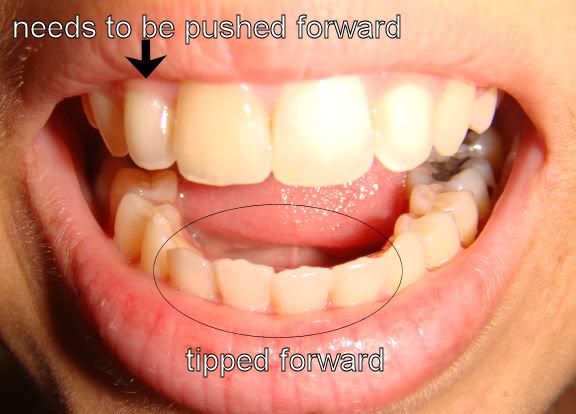 forward lower incisors tipped metal don mouth looks else anyone had