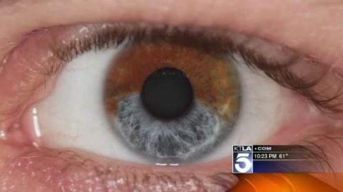 still image from news footage of brown eye being turned blue by laser procedure