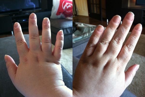 images of my hands before and after; the first one is very swollen and the second is just my chubby hand looking pretty normal