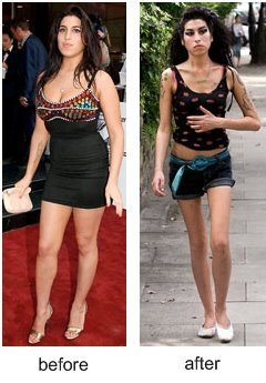 Amy Winehouse is probably anorexic