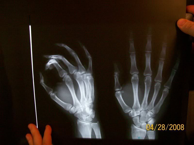 X-ray of Shad's broken finger