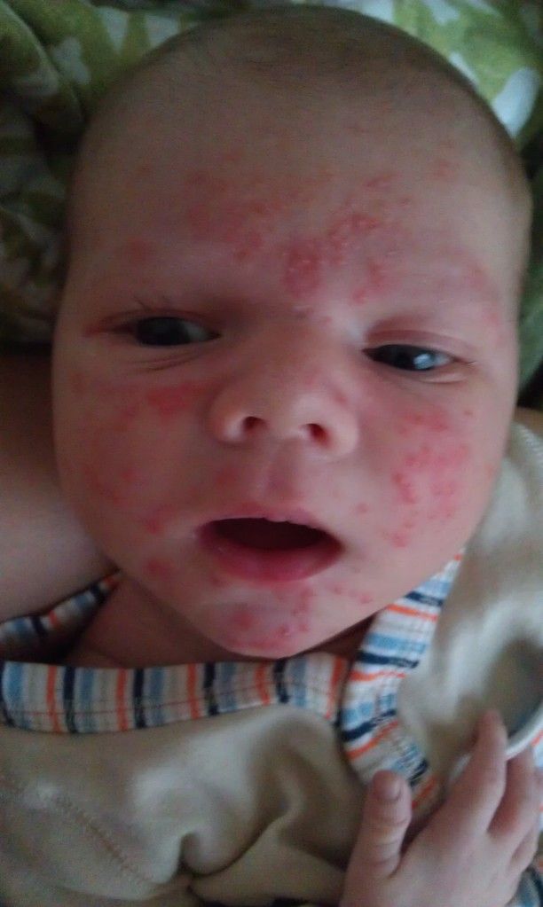 Bad Baby Acne Pics Experiences Babycenter