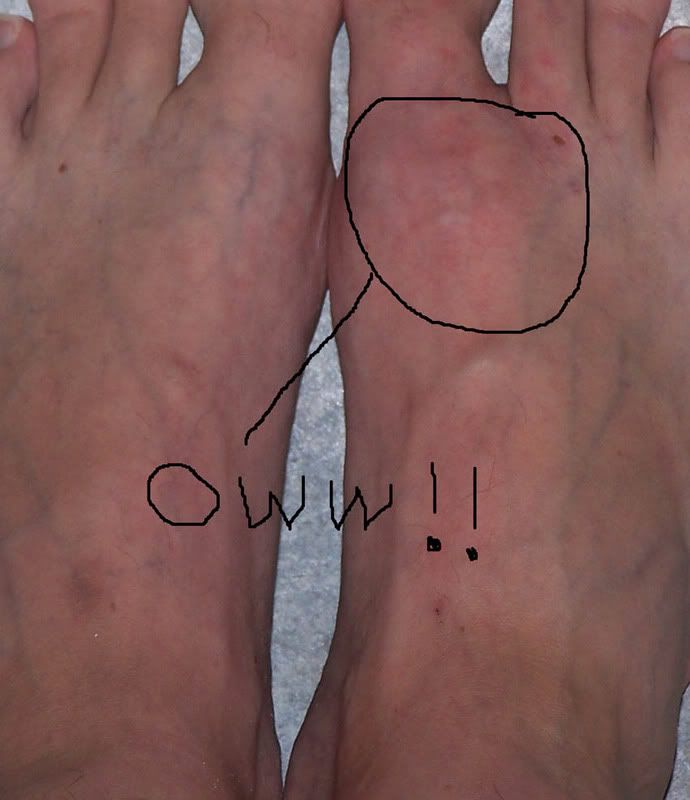 What does gout on feet look like?