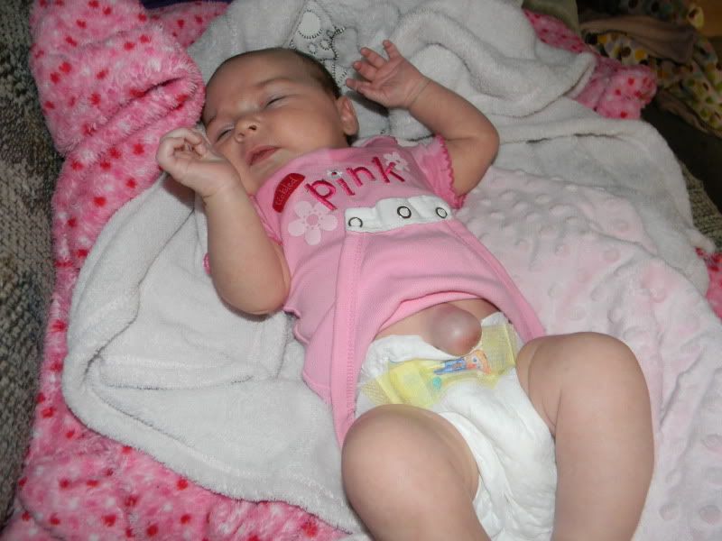 Herniated Belly ButtonPics BabyCenter