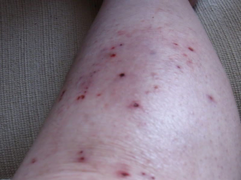 Sores From Diabetes