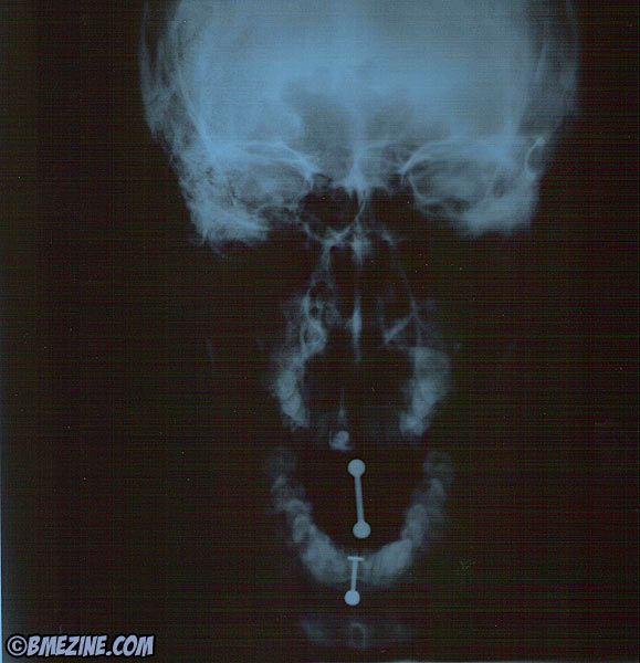 deepthroat xray