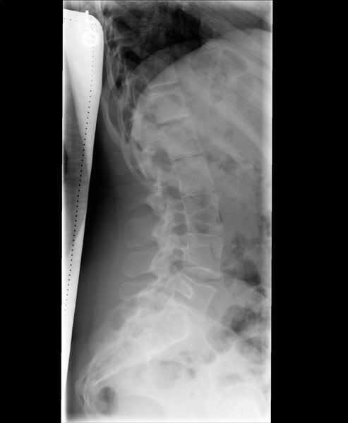 lumbar radiculitis icd 10