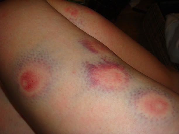 bruises after paintballing