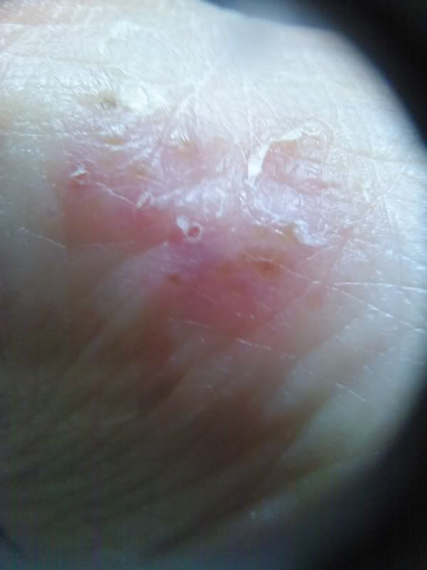 Skin rash - Sarcoidosis