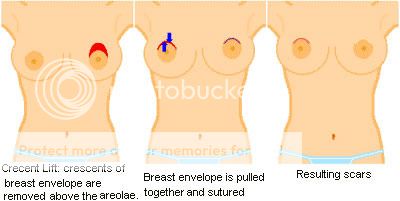 How long are boobs sore for post op? ABB0CE46-9D39-4223-A75E-F5789B75DA95_zpswyiygjq7