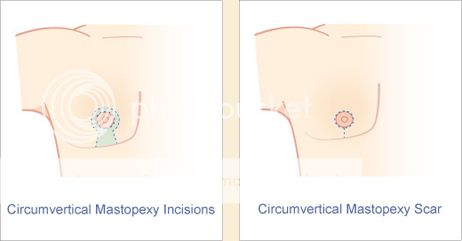 breas enlargement and uplift  E8ca1b114daae8603f6d8372eb3d1b05_zpsf81feae0