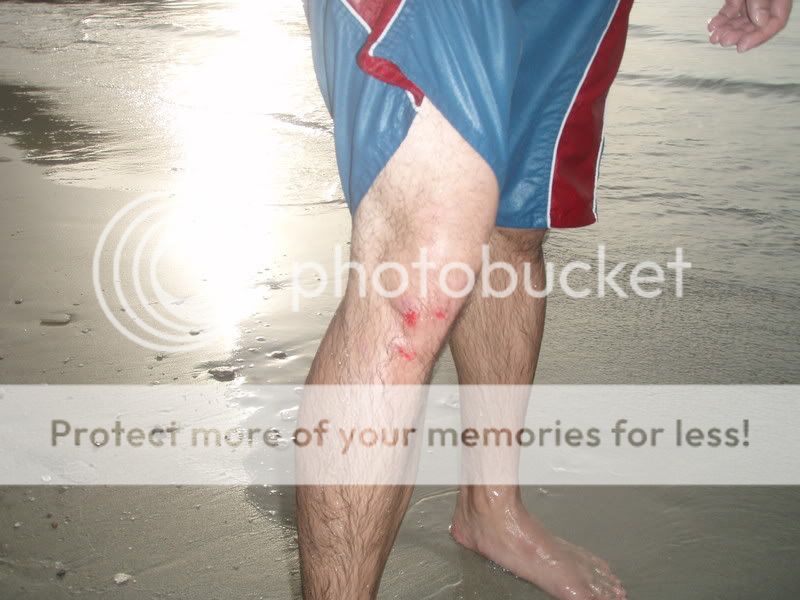 the gnarliest battle scar you've had from skimboarding!!! - Page 2 Ternate54