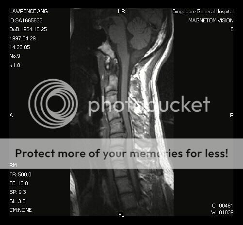 MRI C5-C6 Cervical Spondylosis Photo by LaoKaYu | Photobucket