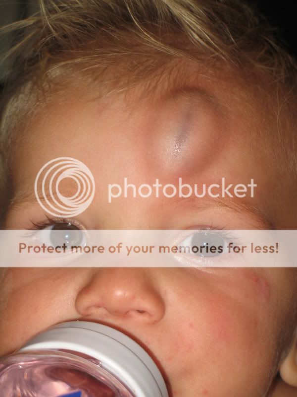 Bruised Child... BabyCenter
