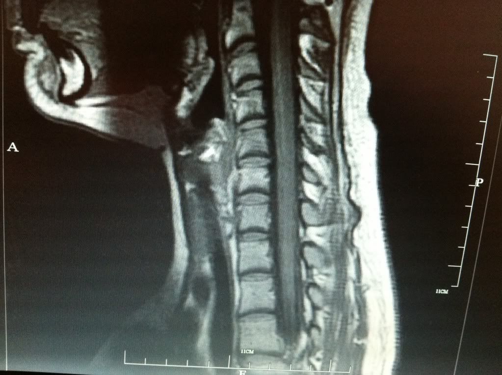 Cervical Spine MRI - Neck Pain: Cervical